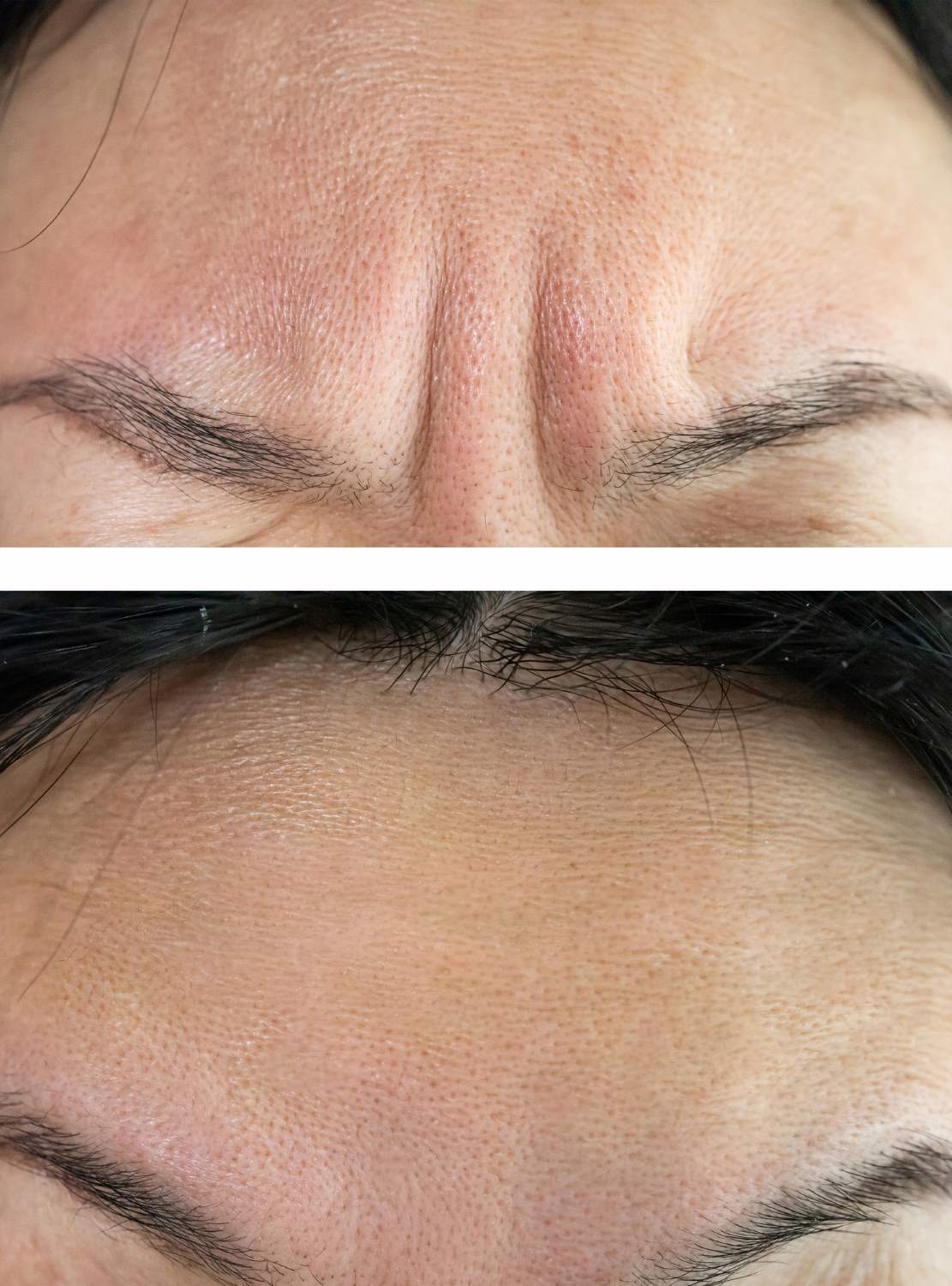 Botox 11's before and after Wellington, FL