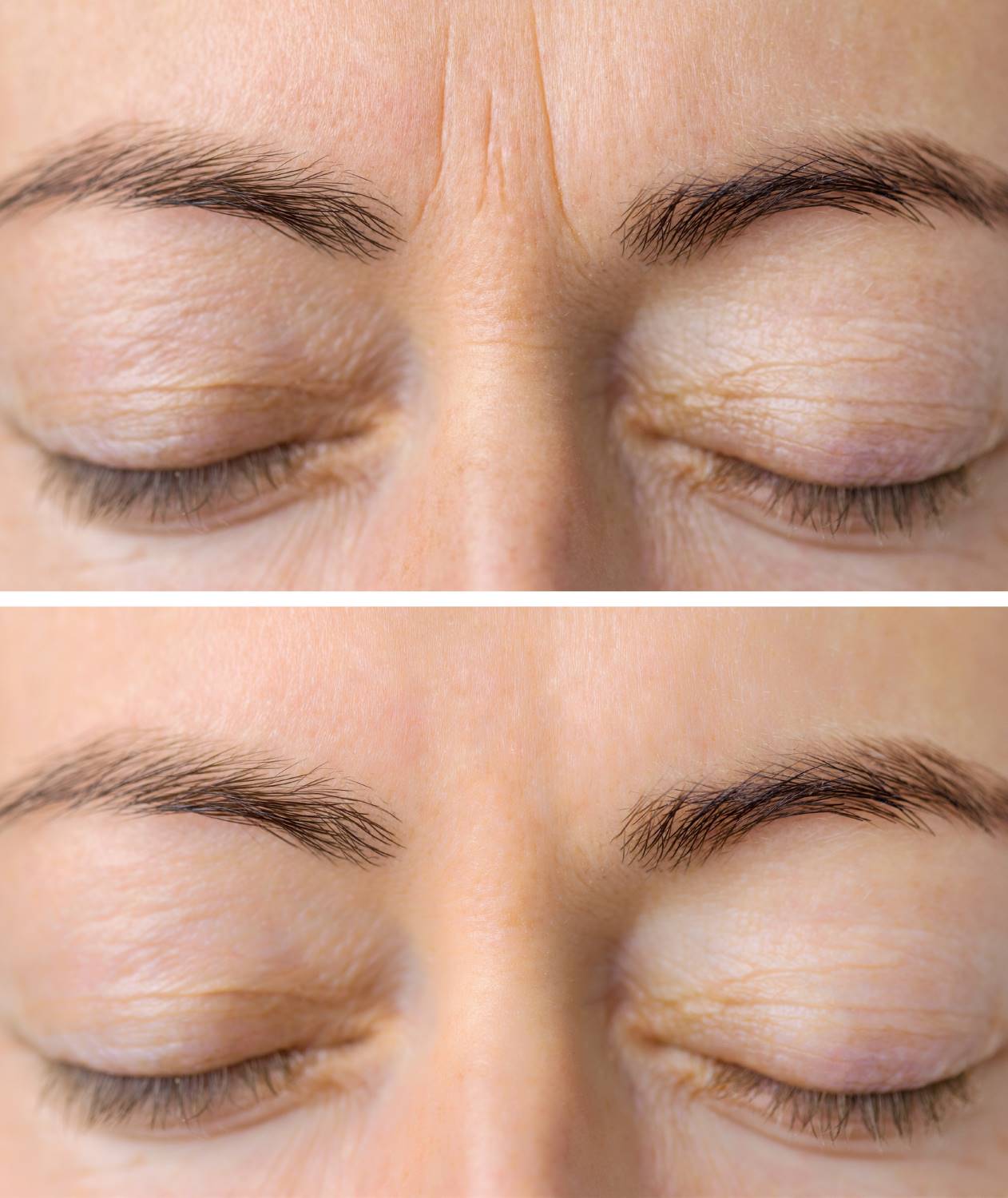 Botox 11s before and after Wellington, FL