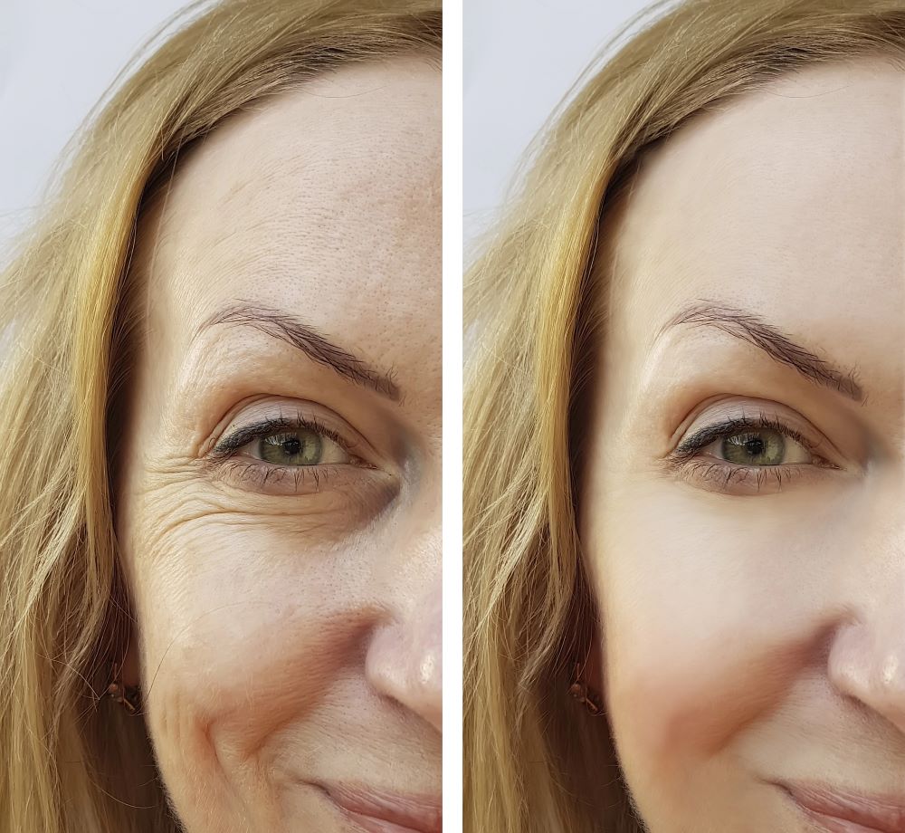 Botox in Wellington, FL by Beyond Concierge Healthcare