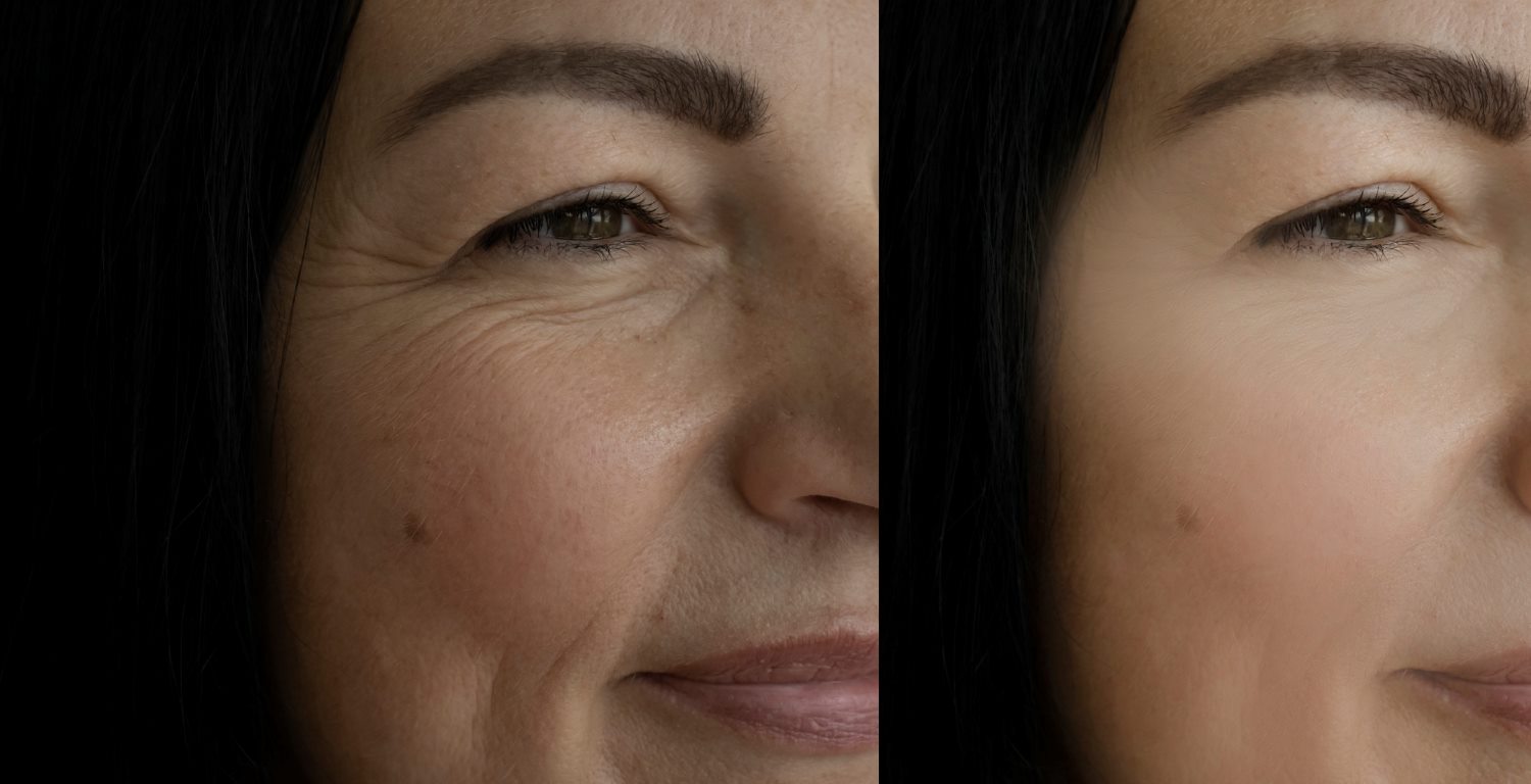 Botox crows feet before and after Wellington, FL