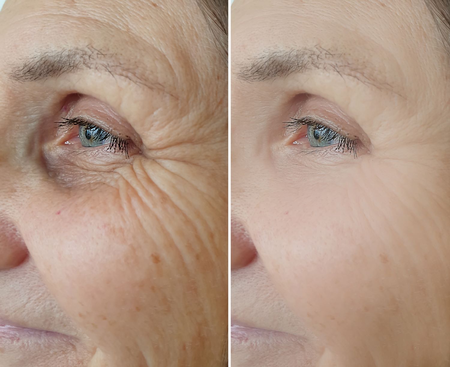 Botox crows feet before and after Wellington, FL