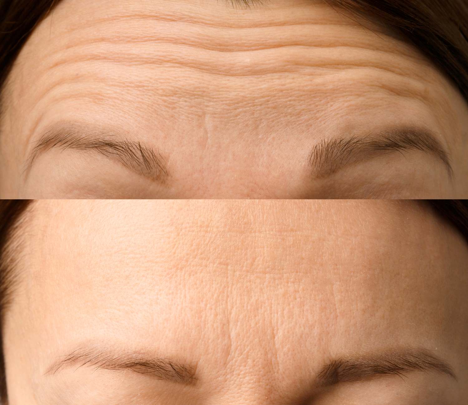 Botox forehead before and after Wellington, FL