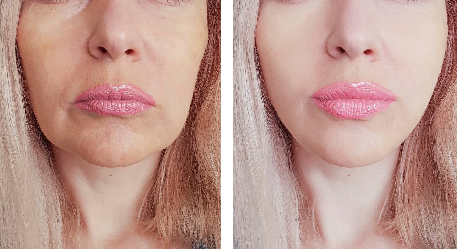 Botox lip flip before and after Wellington, FL