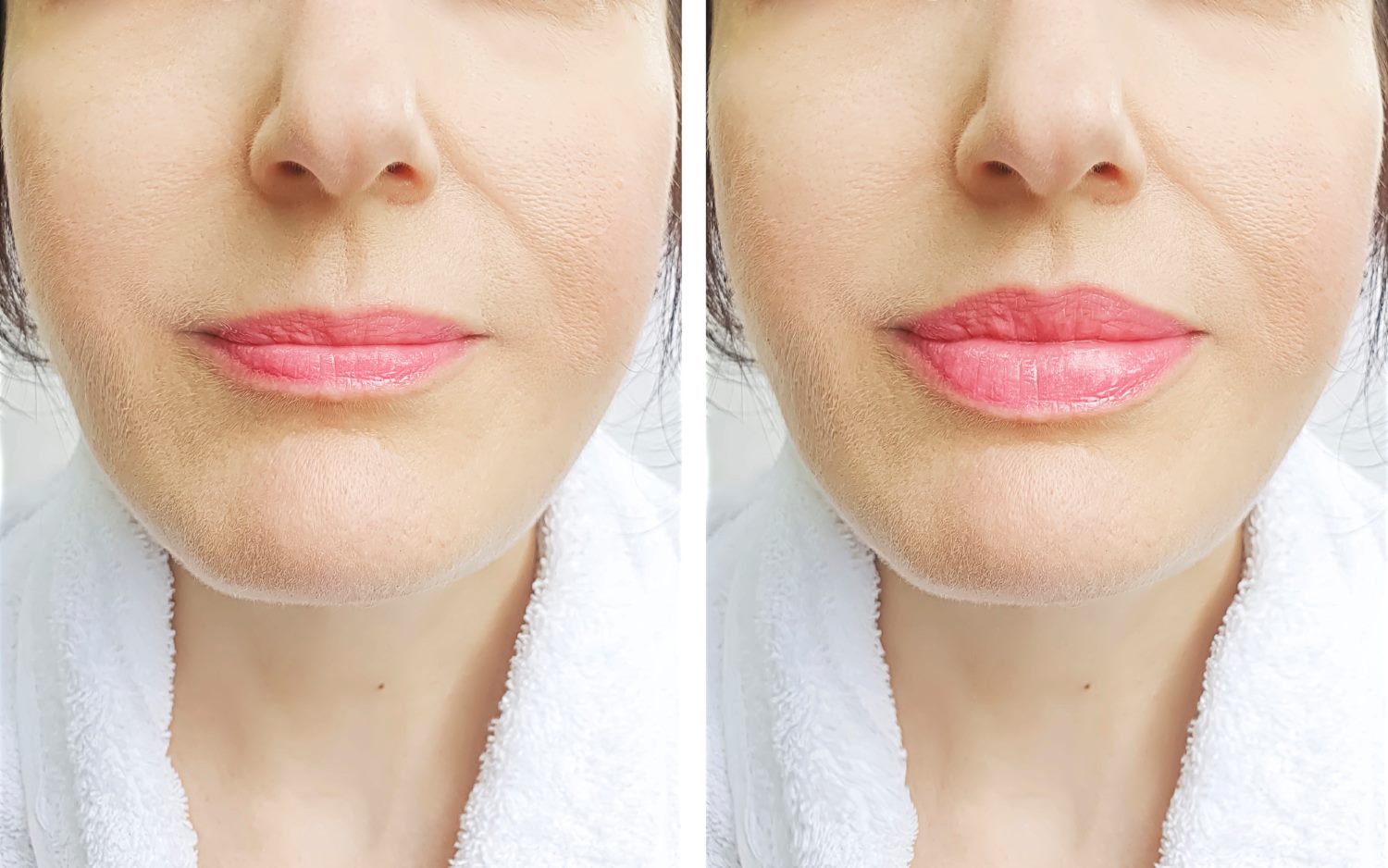 Botox lip flip before and after Wellington, FL