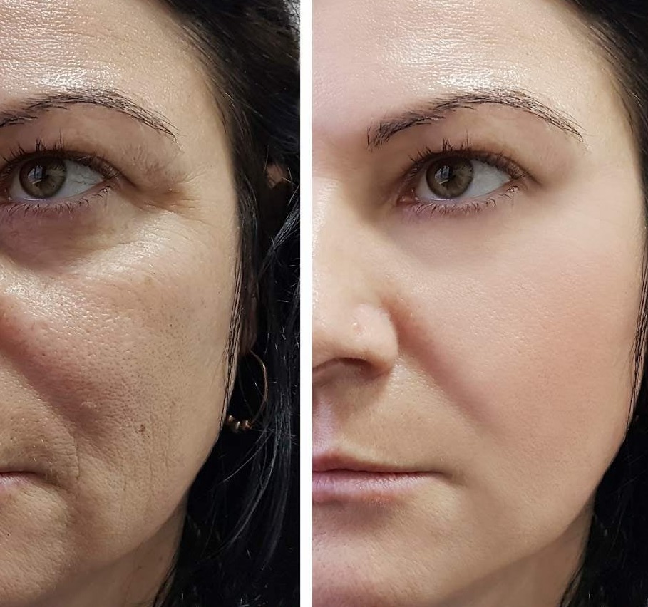 At-Home Cosmetic and Aesthetic Procedures in Loxahatchee, FL by Beyond Concierge Healthcare