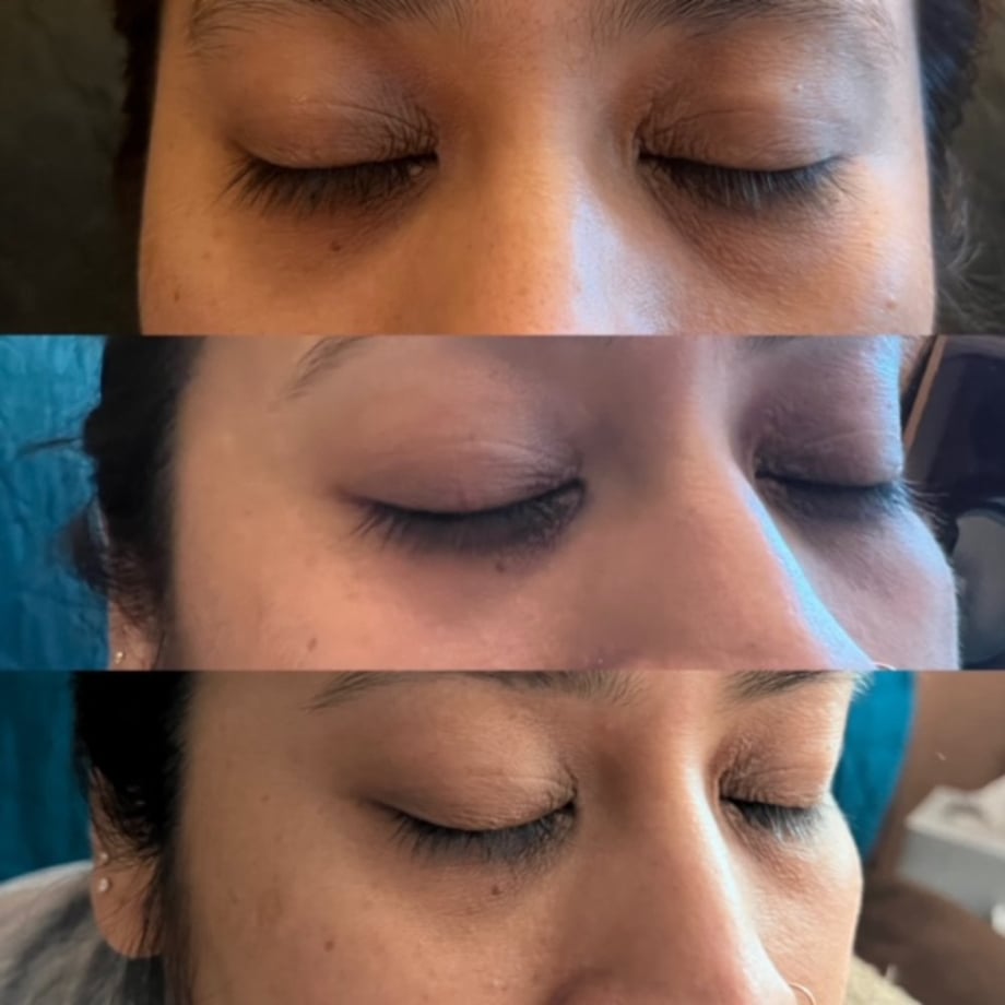 At-Home Aesthetic Procedures Before and After Palm Beach Gardens, FL