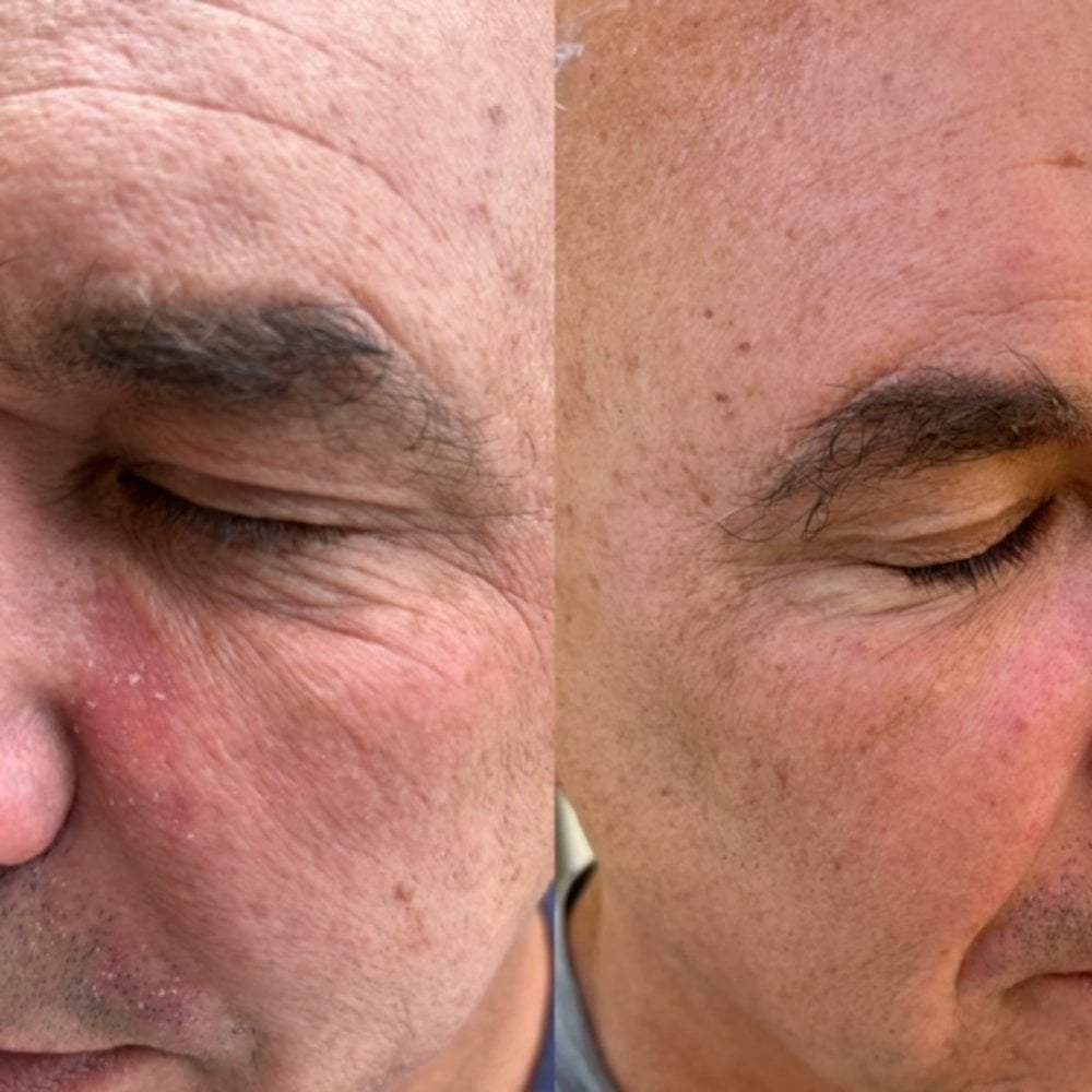 At-Home Aesthetic Procedures Before and After Palm Beach Gardens, FL
