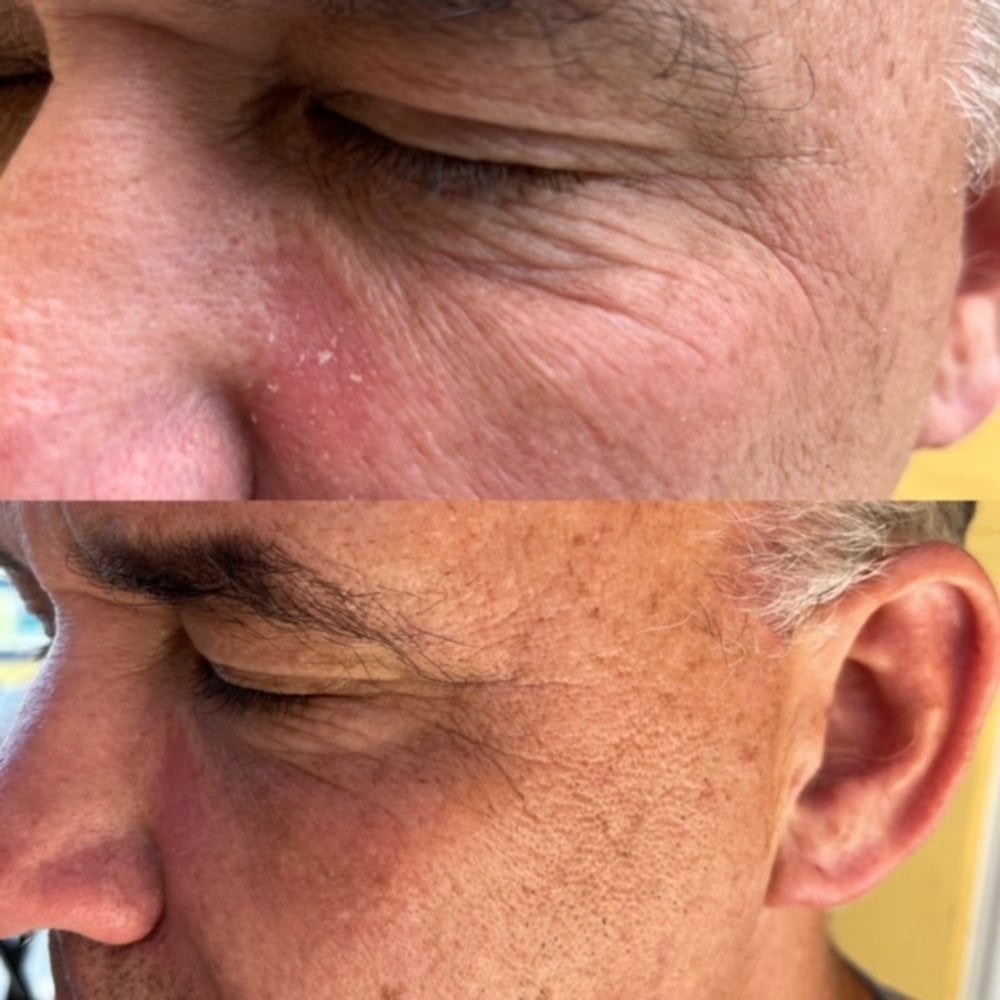 At-Home Aesthetic Procedures Before and After Palm Beach Gardens, FL