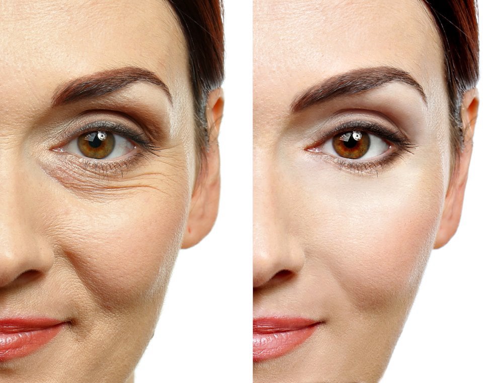 At-Home Aesthetic Procedures Before and After Palm Beach Gardens, FL