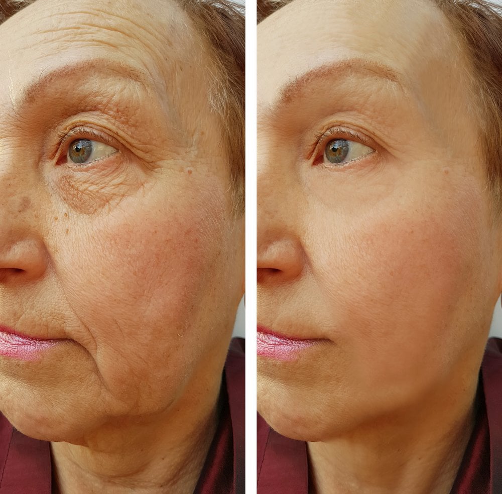 At-Home Aesthetic Procedures Before and After Palm Beach Gardens, FL