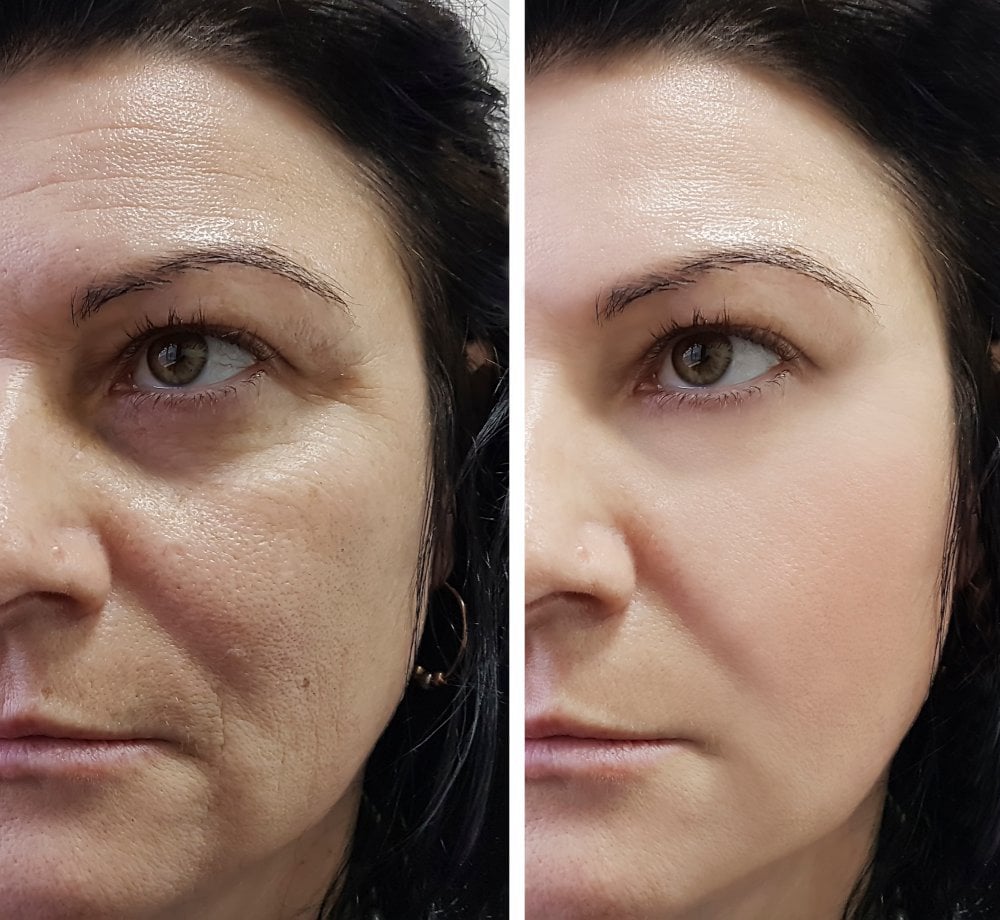 At-Home Aesthetic Procedures Before and After Palm Beach Gardens, FL