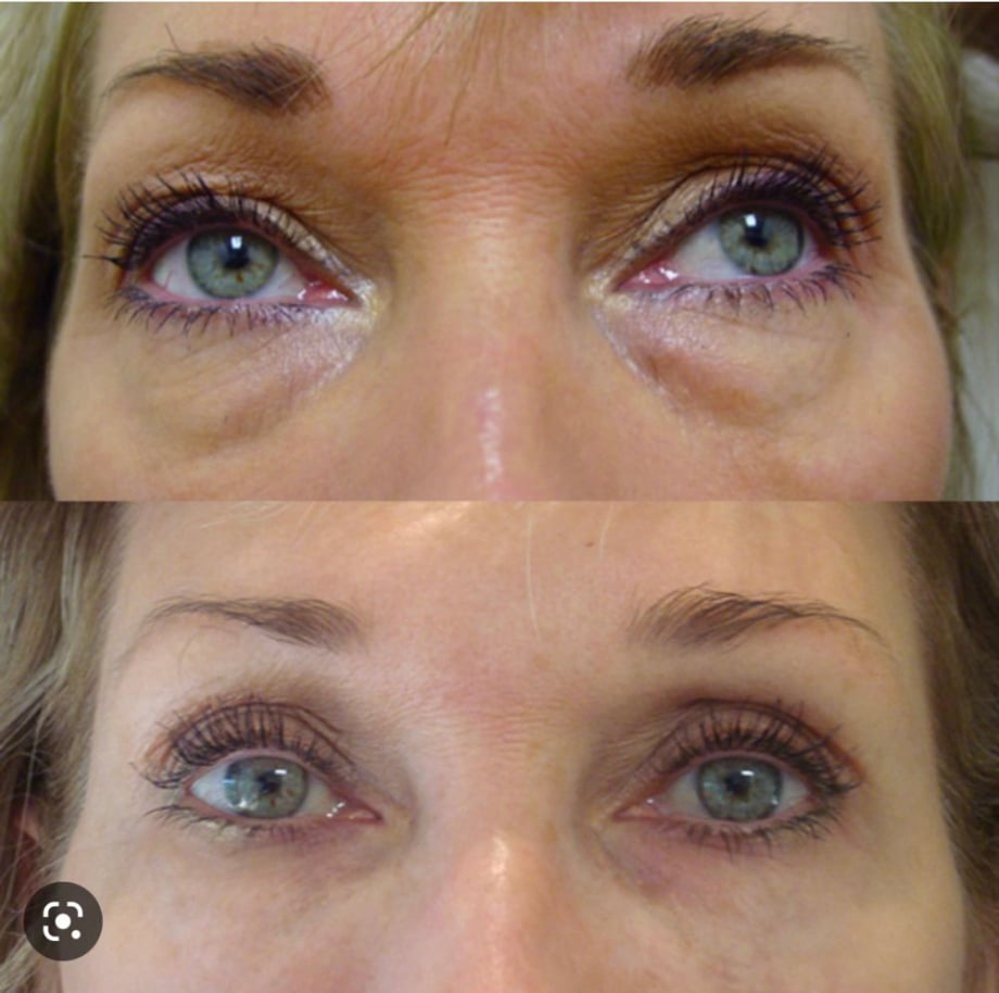 At-Home Aesthetic Procedures Before and After Palm Beach Gardens, FL