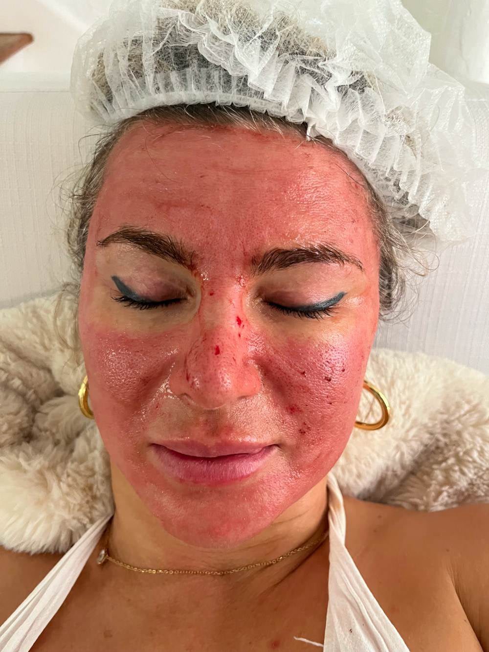 Vampire Facial Treatment in Loxahatchee, FL by Beyond Concierge Healthcare