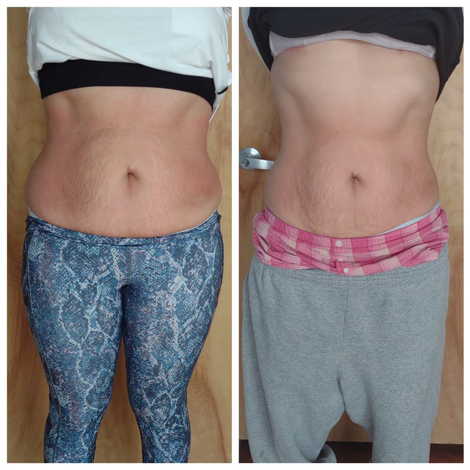 Cryotherapy Treatments before and after Wellington, FL