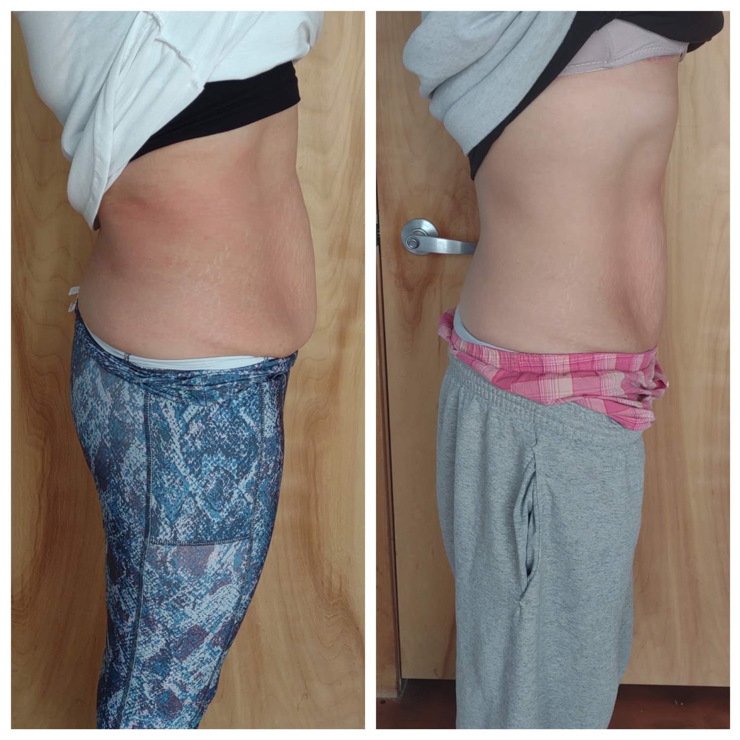 Cryotherapy Treatments before and after Wellington, FL
