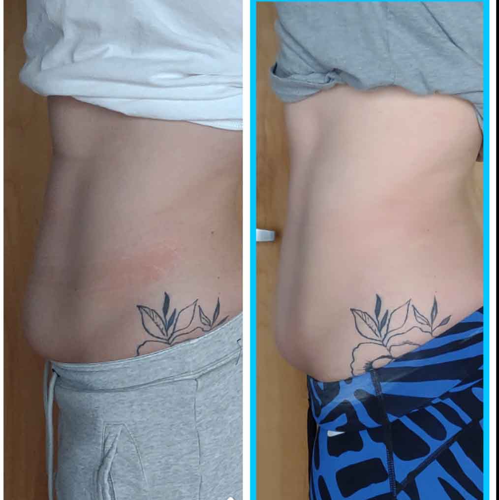 Cryotherapy Treatments before and after Wellington, FL