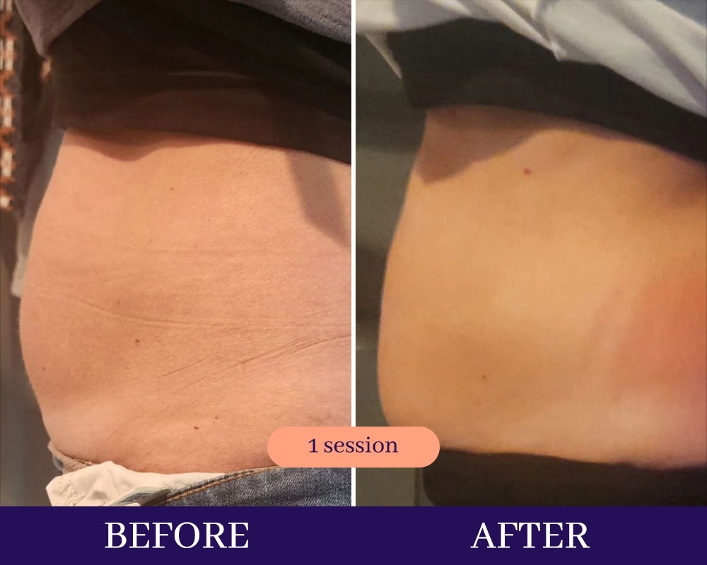 Cryotherapy Treatments before and after Wellington, FL