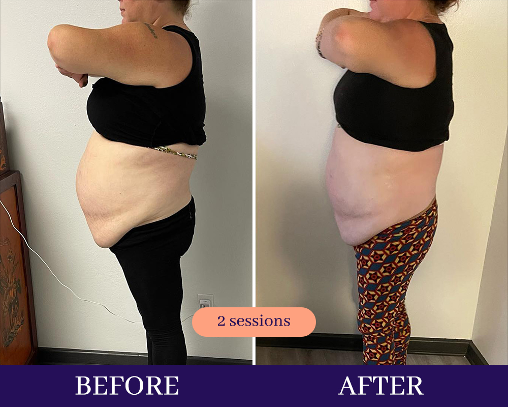 Cryotherapy Treatments before and after Wellington, FL