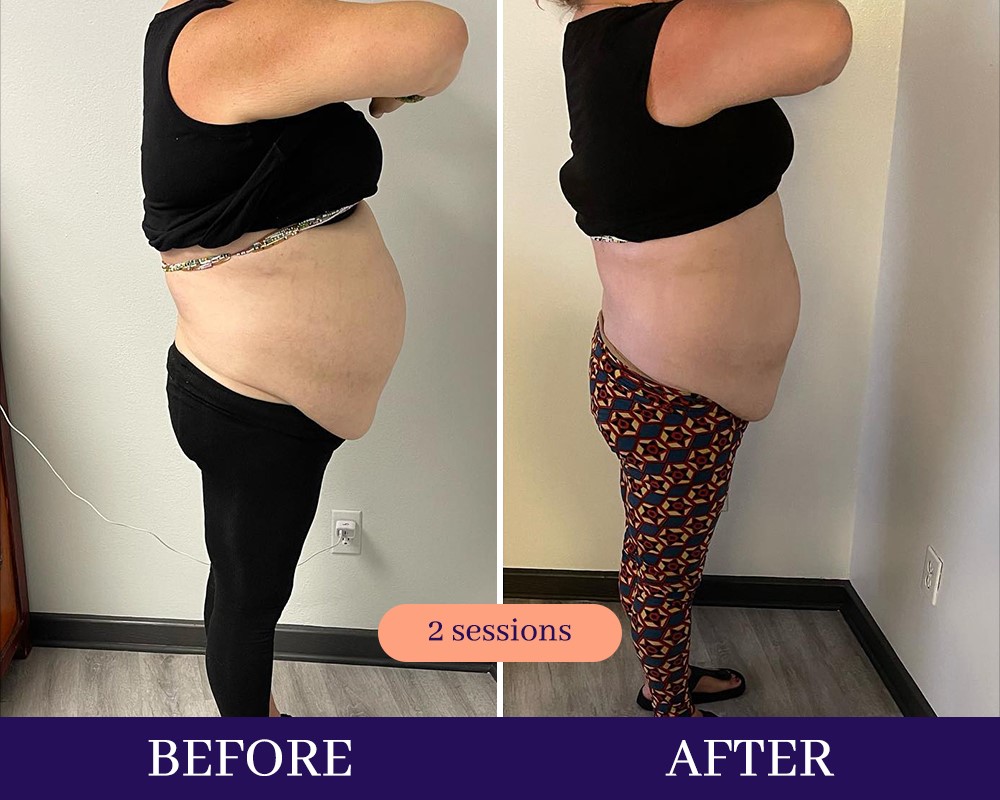 Cryotherapy Treatments before and after Wellington, FL