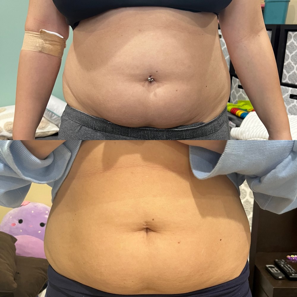 Cryotherapy Treatments before and after Wellington, FL
