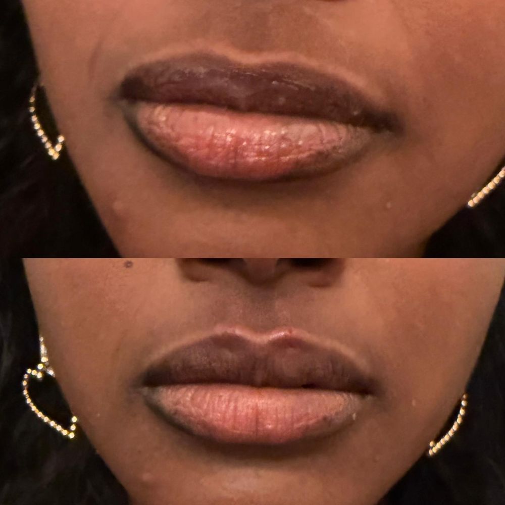 Dermal Fillers in Wellington, FL by Beyond Concierge Healthcare