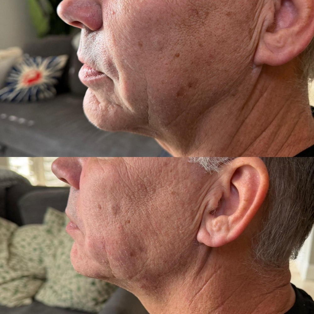 Dermal Fillers in Wellington, FL