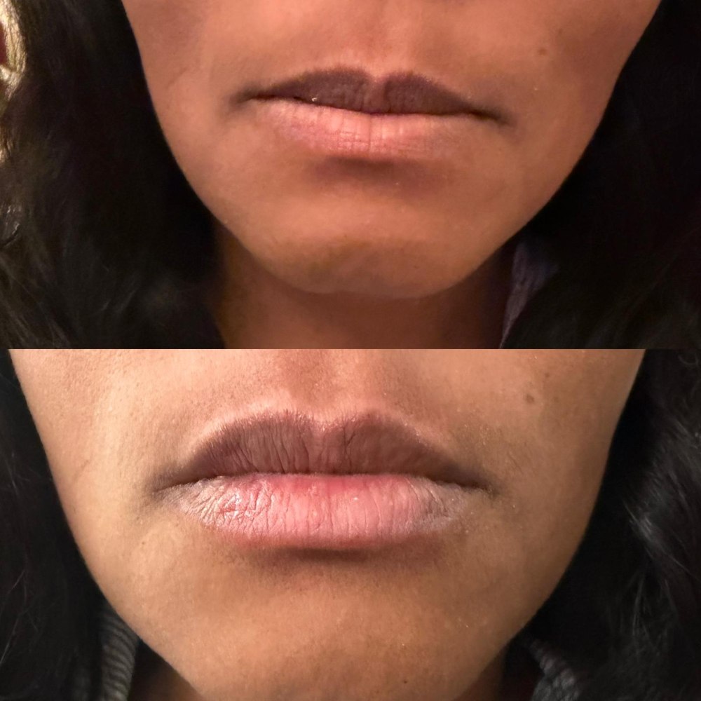 Dermal Fillers in Wellington, FL