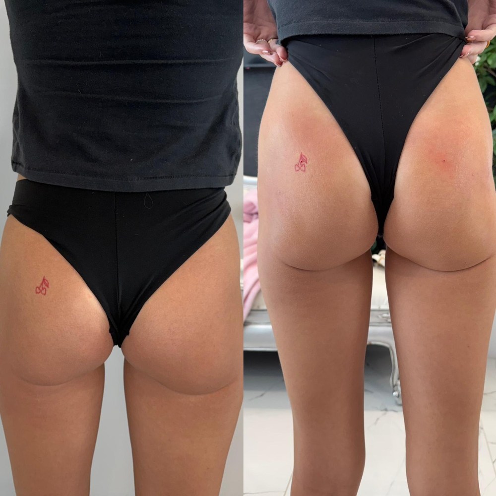 Dermal Fillers in Wellington, FL