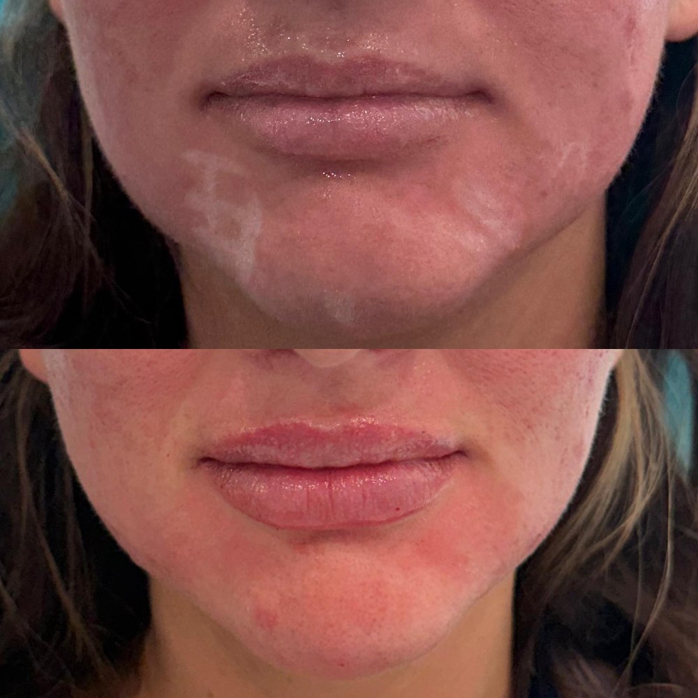 Dermal Fillers in Wellington, FL