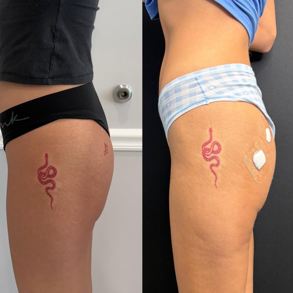 Dermal Fillers in Wellington, FL