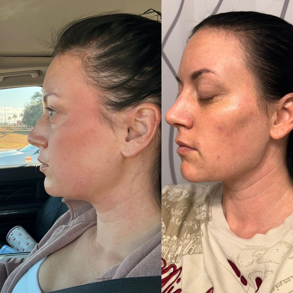 Dermal Fillers in Wellington, FL