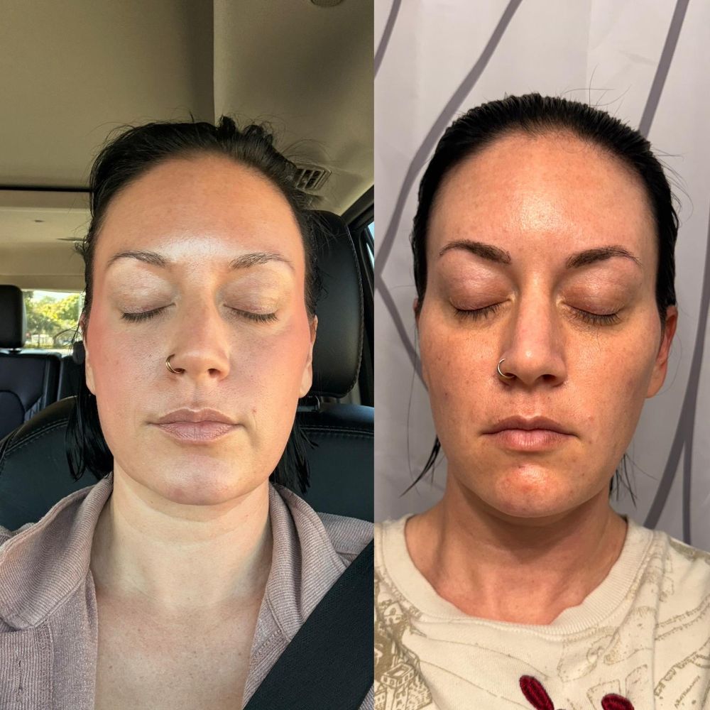 Dermal Fillers in Wellington, FL