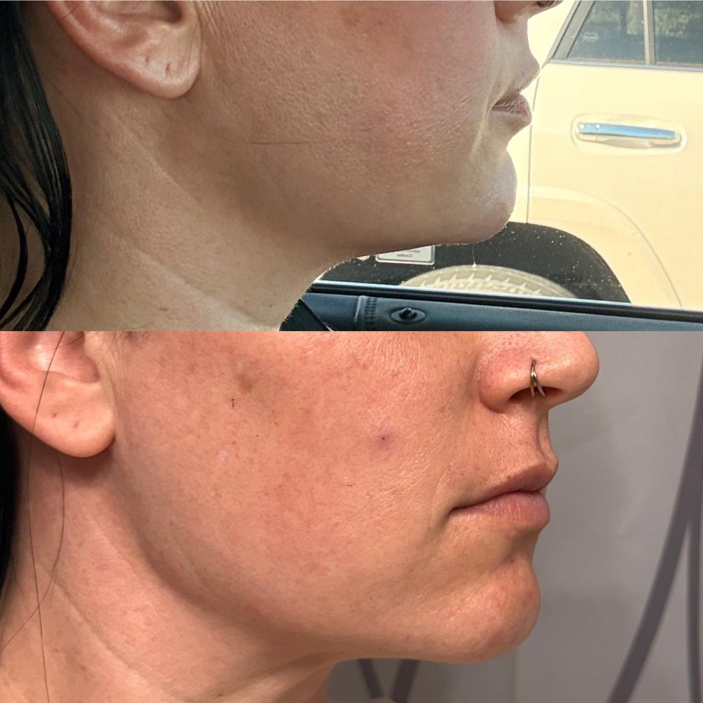 Dermal Fillers in Wellington, FL