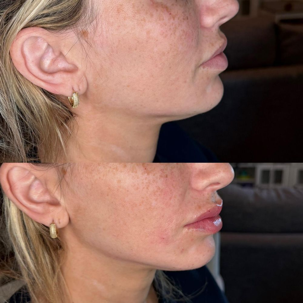Dermal Fillers in Wellington, FL