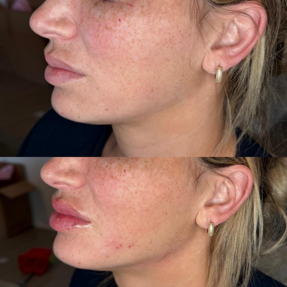 Dermal Fillers in Wellington, FL