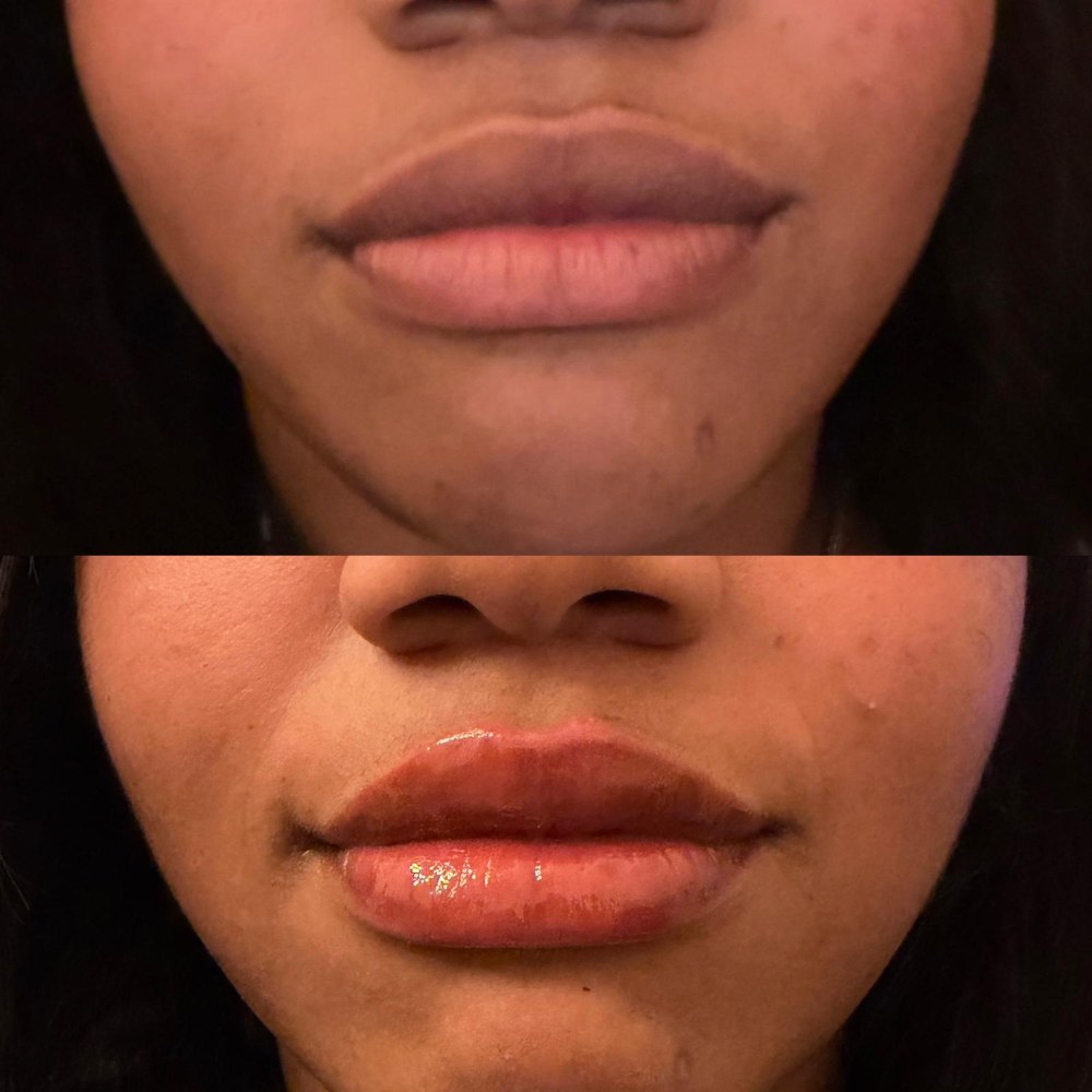 Dermal Fillers in Wellington, FL