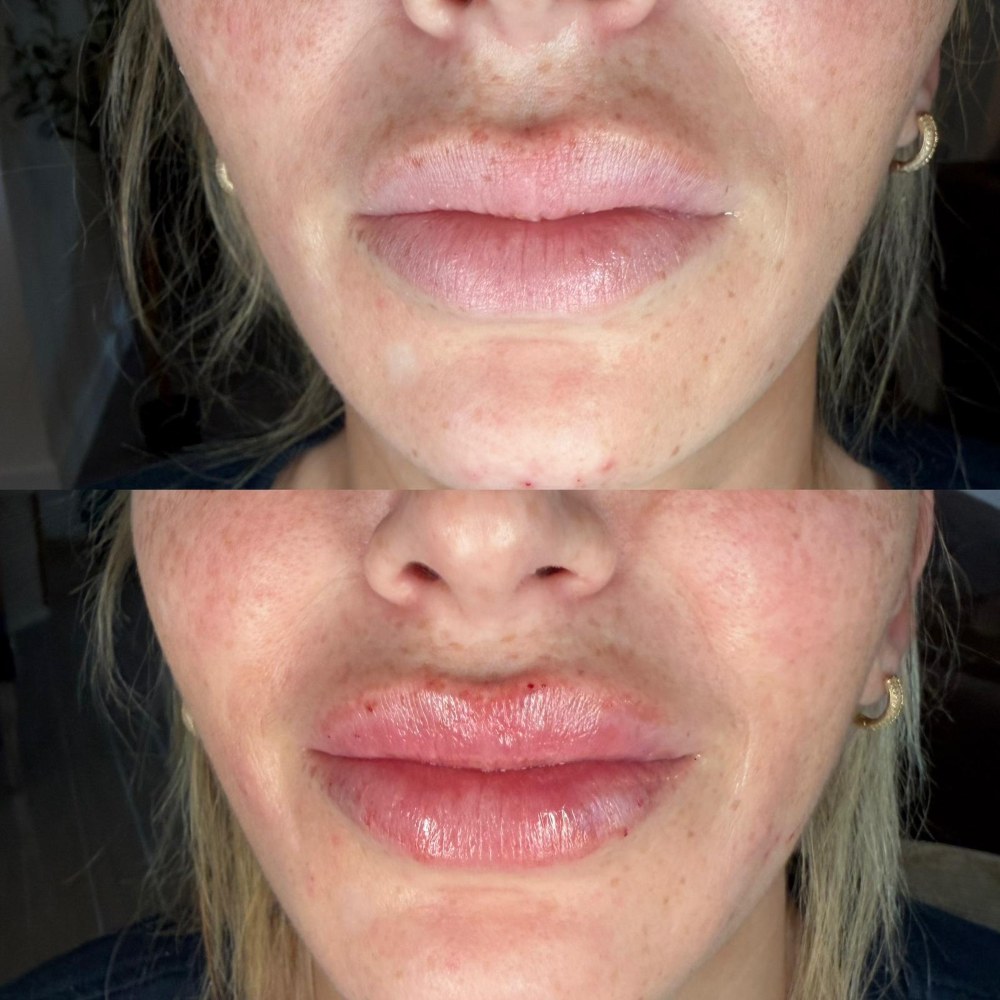 Dermal Fillers in Wellington, FL