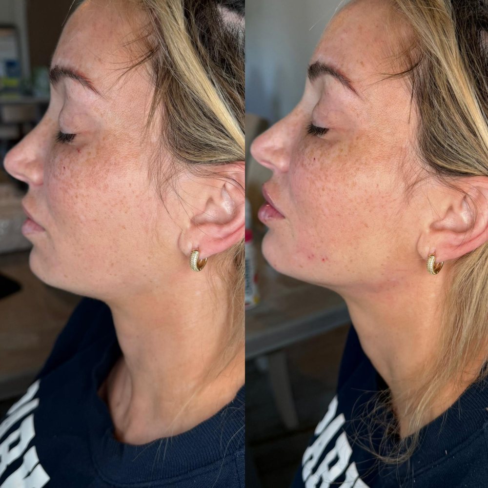Dermal Fillers in Wellington, FL