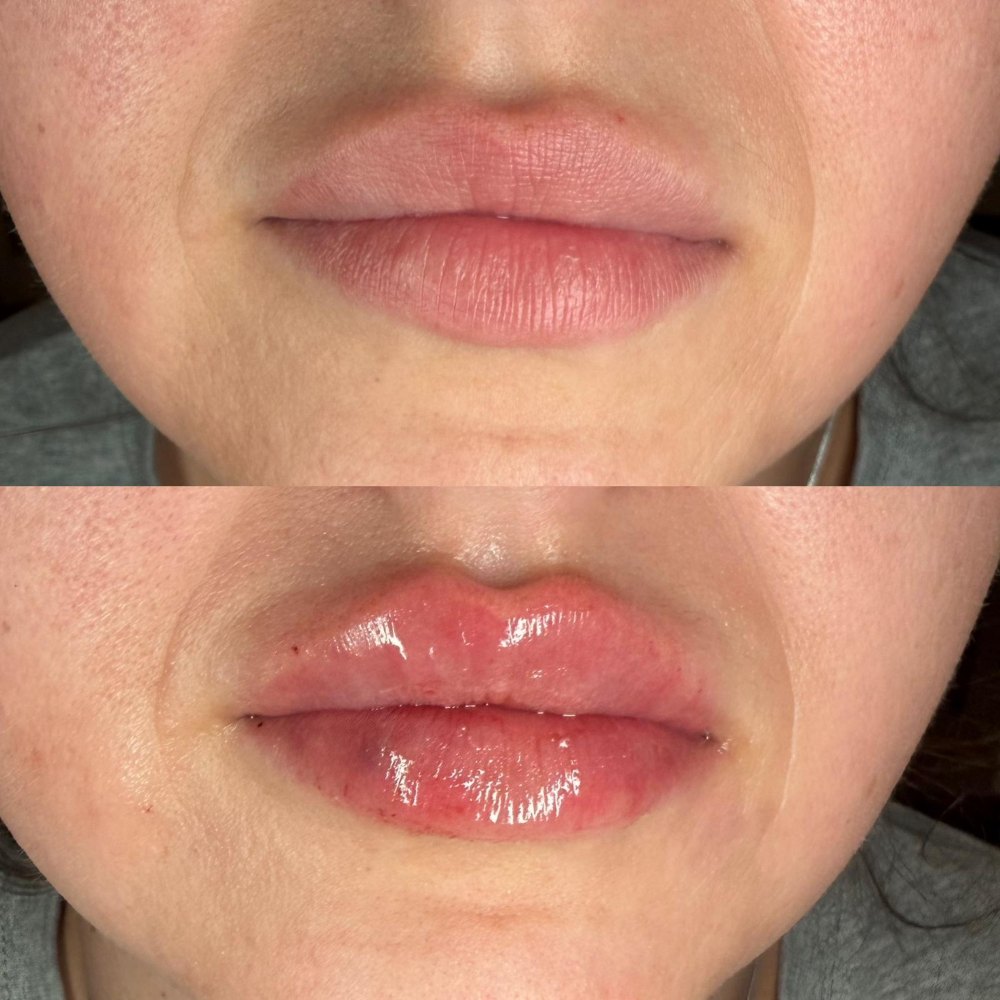 Dermal Fillers in Wellington, FL