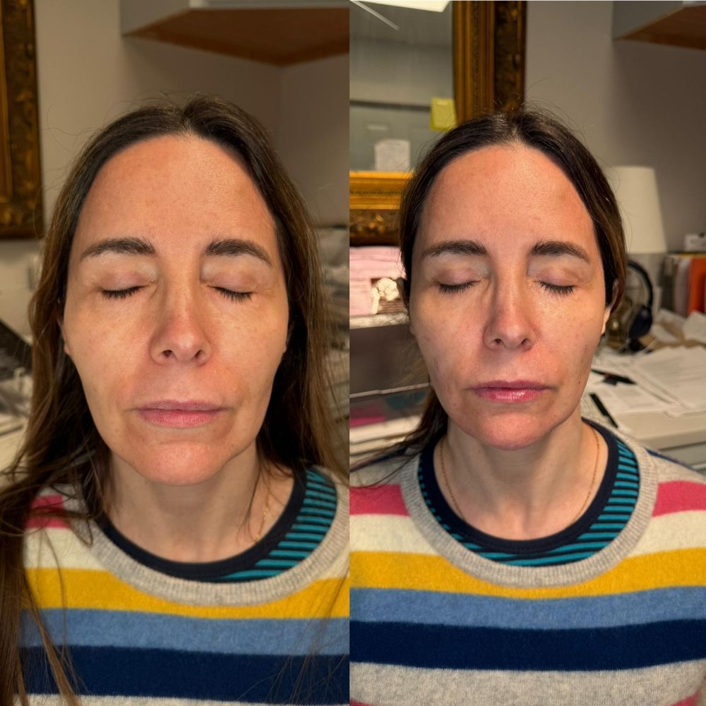 Dermal Fillers in Wellington, FL by Beyond Concierge Healthcare