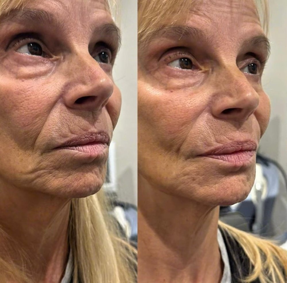 Dermal Fillers in Wellington, FL by Beyond Concierge Healthcare