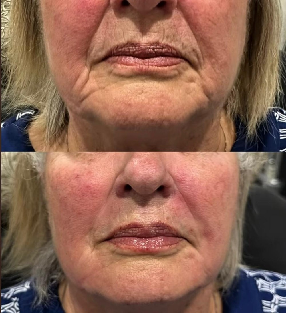 Dermal Fillers in Wellington, FL by Beyond Concierge Healthcare