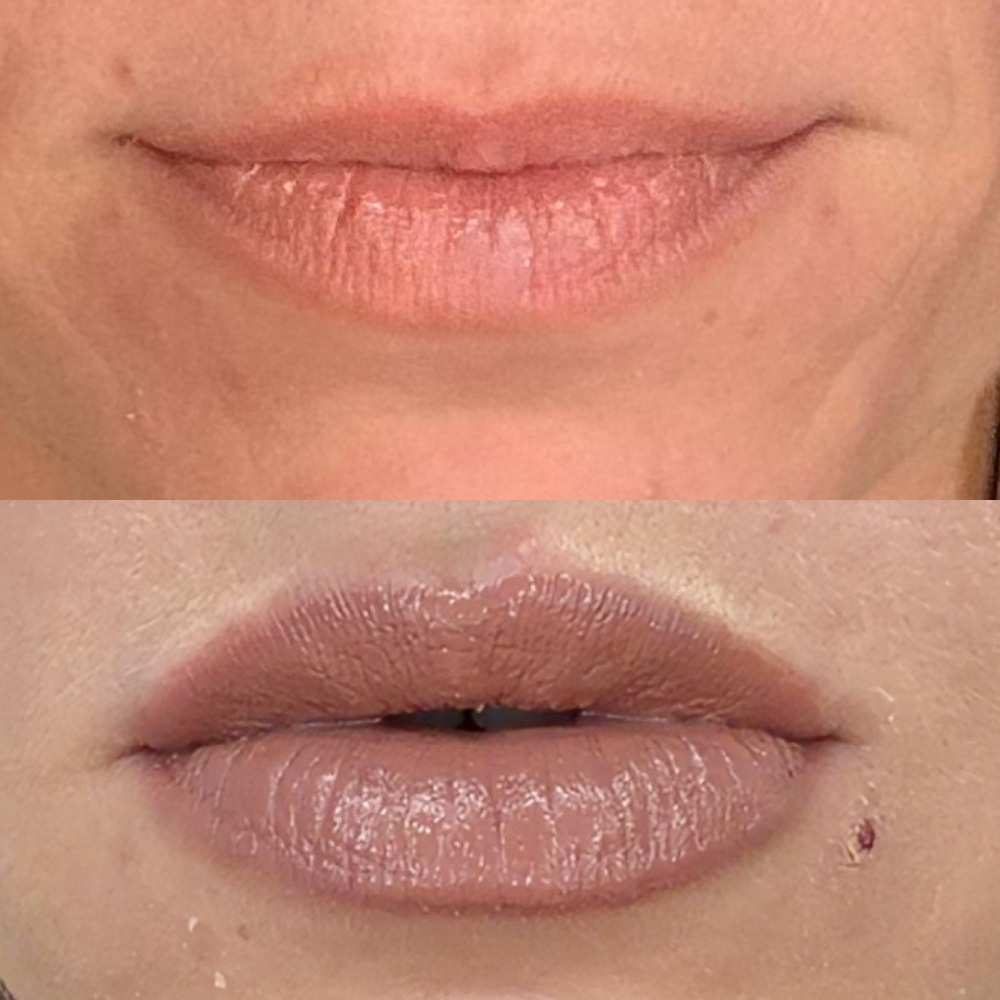 Dermal Fillers in Wellington, FL