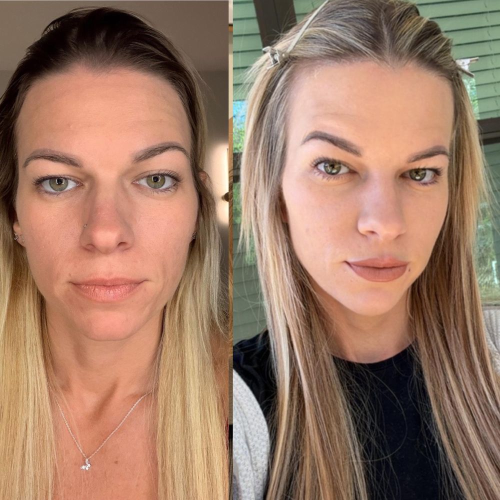 Dermal Fillers in Wellington, FL