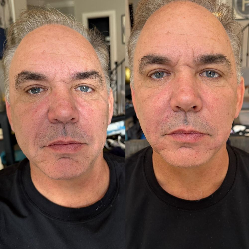 Dermal Fillers in Wellington, FL