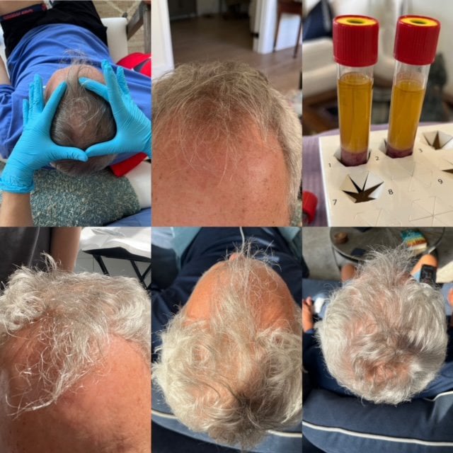 Hair Growth Before and After Loxahatchee, FL