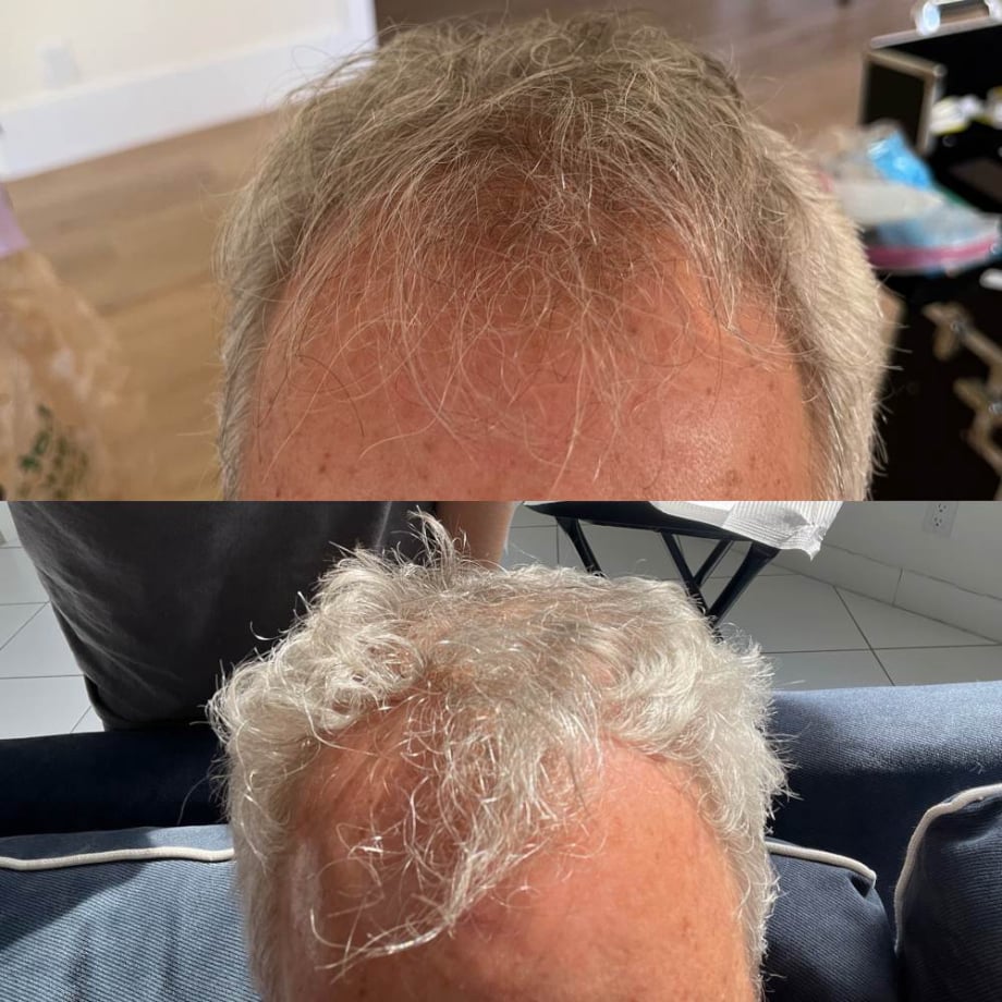 Hair Growth Before and After Loxahatchee, FL