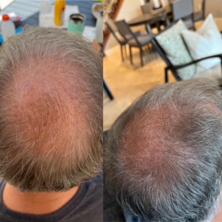 Hair Growth Before and After Loxahatchee, FL