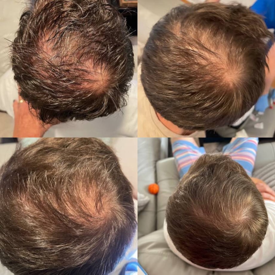 Hair Growth Before and After Loxahatchee, FL
