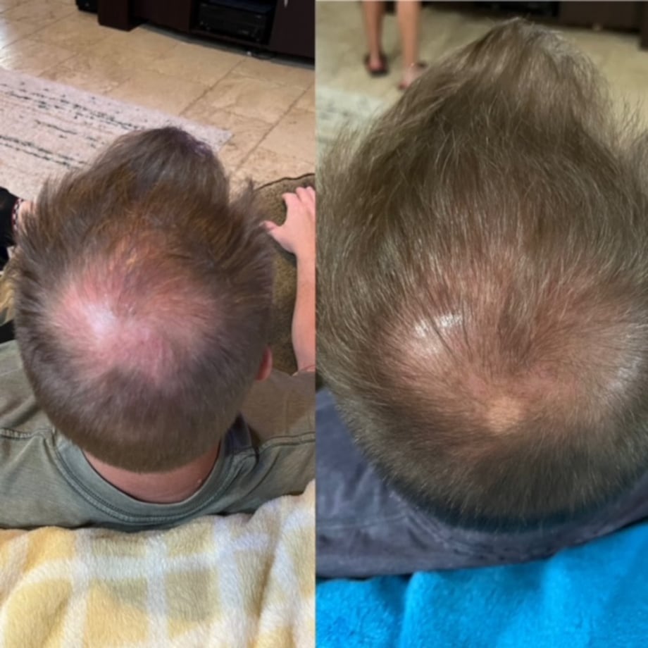 Hair Growth Therapy in Loxahatchee, FL by Beyond Concierge Healthcare